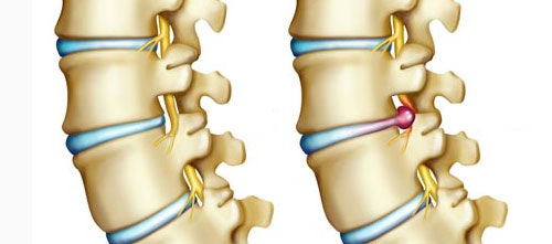 Spinal disc herniation (Discus hernia, slipped disc)