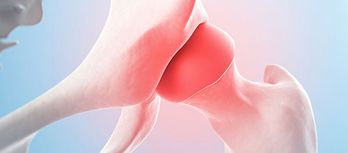 Endoproteza kuka i kolena