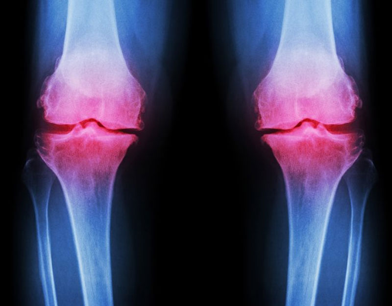 bol interfalangealnim zglobova liječenje magnetom artroze koljena
