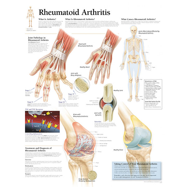 artritis reumatskih bolova